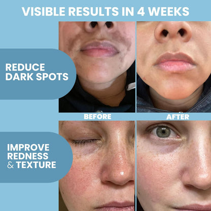 Azelaic Acid Serum for Face – Niacinamide, Hyaluronic Acid, Vitamins A+C+E – Redness Relief, Dark Spots, Uneven Skin Tone, Texture, Pores, Topical Booster for Clearer, Smoother Skin, 2Oz